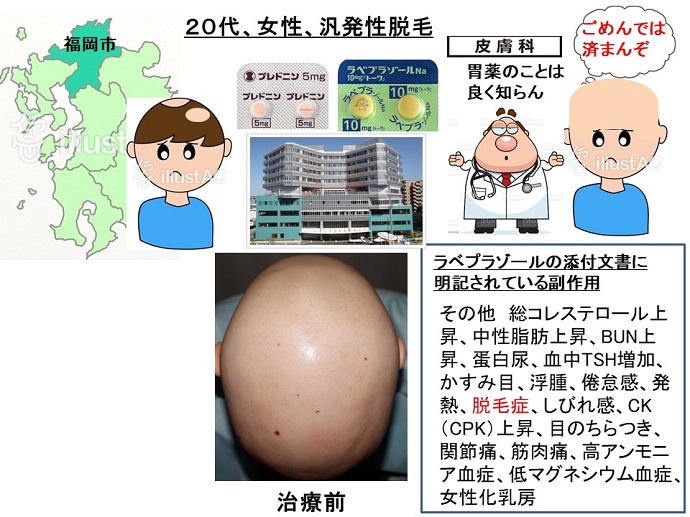 円形脱毛症　病院